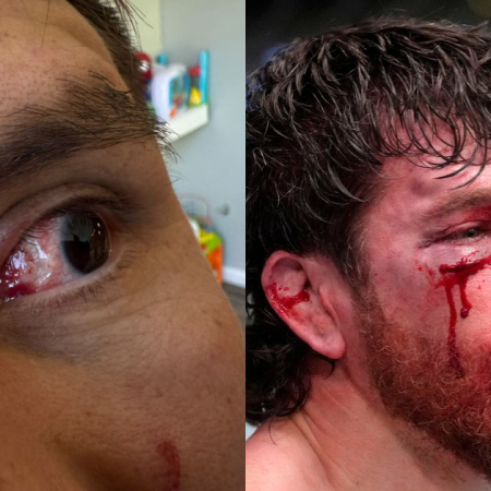 “Will It Take Someone Losing an Eye?” – Jim Miller Rips UFC’s Lack of Action on Eye Pokes
